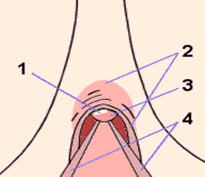Drawing of clitoral hood with smegma (6804 bytes)