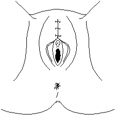 Appearance of Type II FGM after suture (1609 bytes)