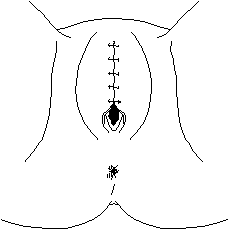 Appearance of Type III FGM after suture (1436 bytes)