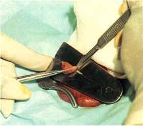 Photo, infant circumcision using a Mogen Clamp (8228 bytes)