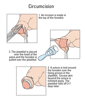 Bell Circumcisions