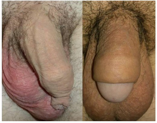Excessive foreskin image